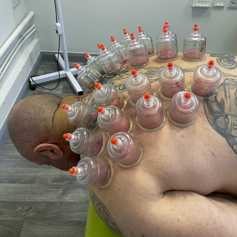 Man's back covered in cups'